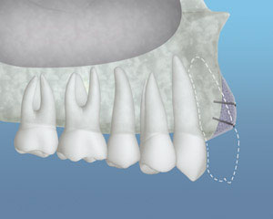 Dental implant bone graft diagram showing restored jawbone around an implant