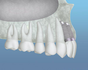 Bone grafting illustration showing added bone supporting a dental implant