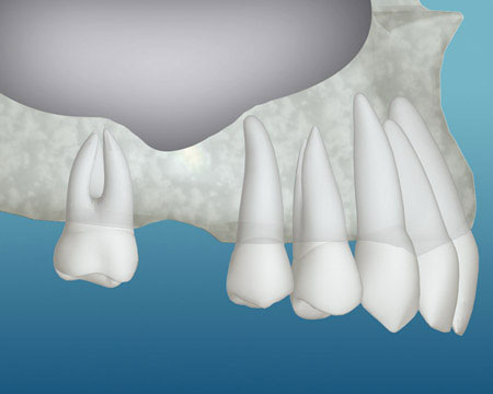 Upper jaw illustration showing bone loss before dental implant bone grafting