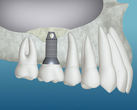 Upper jaw bone graft illustration showing bone preparation for dental implants