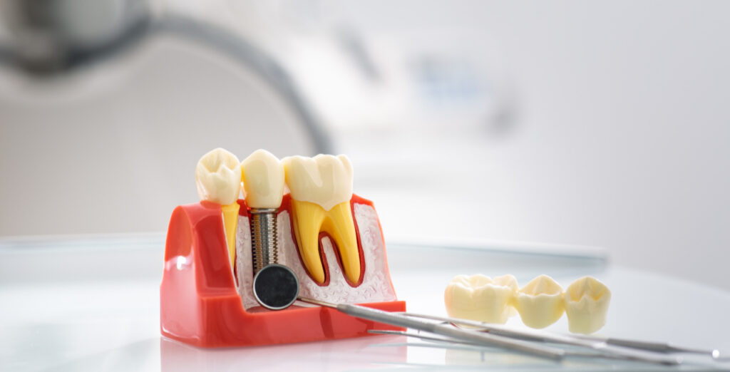Dental implant model showing implant posts and tooth restorations